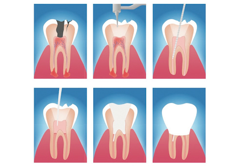 como se hace una endodoncia