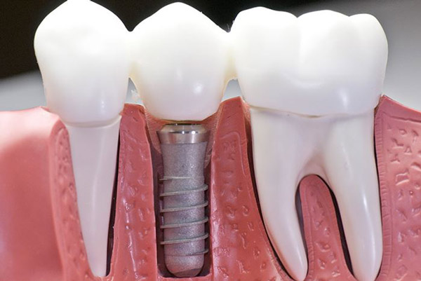 implantes dentales en león