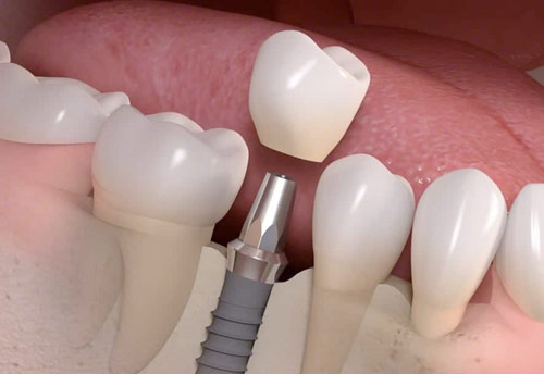 5 preguntas de nuestros pacientes sobre implantes dentales